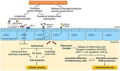 Tubulointerstitial injury in proteinuric chronic kidney diseases